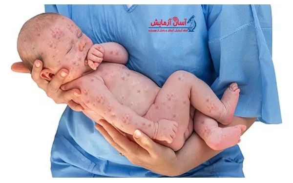 آزمایش HSV در منزل