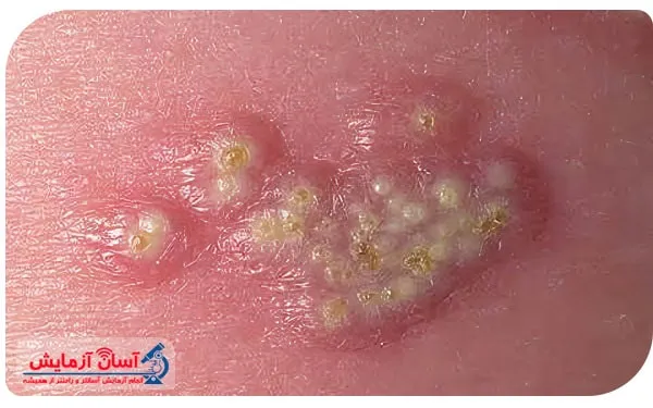 آزمایش تبخال تناسلی در منزل