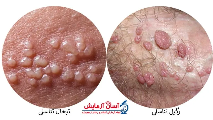 تفاوت تبخال تناسلی با زگیل تناسلی